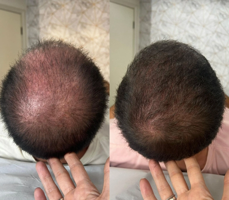 Antes e depois - gabriela