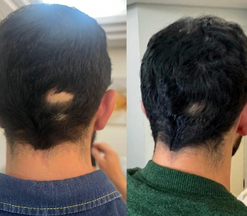 Antes e depois - gabriella